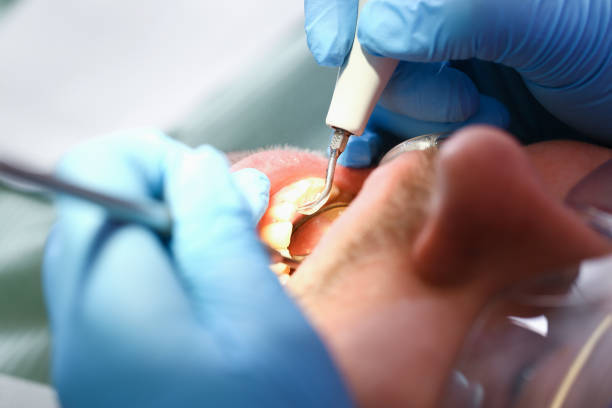 Best Dental Abscess Treatment in Beltsville, MD