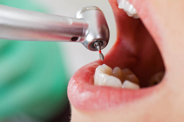 Best Broken or Chipped Tooth Repair in Beltsville, MD